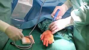 Karpálny tunel endoskopicky | ŽILPO s.r.o.