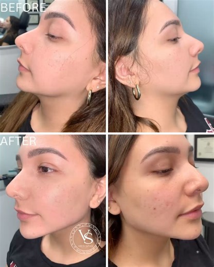 VS Med Spas on Instagram: "Female non-surgical jawline contouring, chin augmentation & cheek contouring. • Purpose: To enhance the jawline, chin & cheeks. How it works: Injection of long lasting dermal fillers. Results: Immediate Note: Individual results vary. Technique: Multi-droplet injections with micro-cannula assistance. Anesthesia: Topical Length of Procedure: 30 min Downtime: None Caution: Must be preformed by an experienced provider. Pain level: None to mild. Initial Private consultation