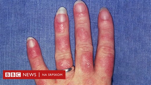 Srbija i zdravlje: Šta je lupus i kako se leči - BBC News na srpskom