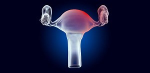 Wanita terpaksa buang rahim akibat ketumbuhan fibroid. Berikut fakta yang perlu kaum Hawa tahu | SinarPlus