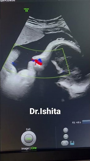 #Fetal_breathing_biophysical_profile