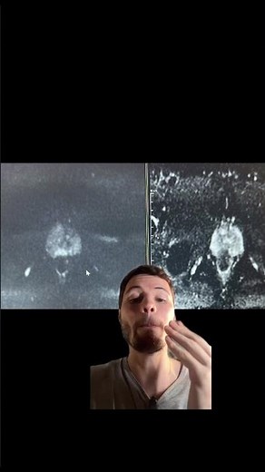 PI-RADS 5 Prostate MRI: how to identify?