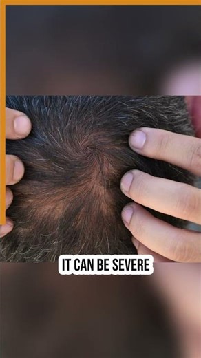 Hair Fall After Dengue or COVID? Telogen Effluvium Explained | Dr. Health Hair & Skin Clinic