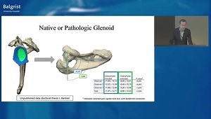 Preoperative Planning and Computer Assisted Surgery in RTSA - Where are We Today and What Do We Really Need
