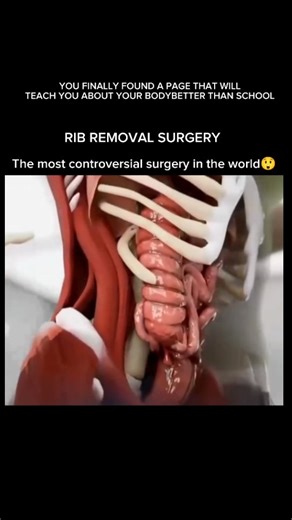 EXPLAINING OUR BODY on Instagram: "“Rib removal” is a major surgical procedure where the lower floating ribs (usually the 11th and 12th) are removed. These ribs protect important organs like your kidneys, spleen, and liver, which is why the surgery is rarely done for cosmetic reasons. Many people online talk about rib removal for a “tiny waist,” but in reality, it’s a high-risk surgery most surgeons do not recommend for body shaping. ❗ Harmful Effects & Risks Rib removal can lead to serious comp