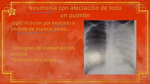 ¿Cómo diferenciar un derrame pleural de atelectasia? Rx de tórax: La radiografía de tórax, comúnmente llamada placa de tórax, es el examen de diagnóstico por rayos X más comúnmente realizado. Una radiografía de tórax genera imágenes del corazón, los pulmones, las vías respiratorias, los vasos sanguíneos y los huesos de la columna y el tórax. Derrame pleural: Acumulación de líquido entre los tejidos que recubren los pulmones y el tórax. Atelectasia: Colapso completo o parcial de un pulmón o parte