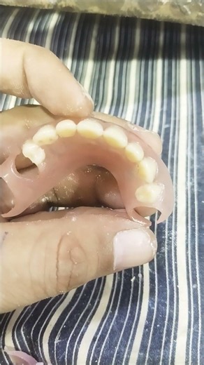 Flexible Removable Partial Denture By Haider #dentalprosthesis #rpddentalprocedure #viralvideo