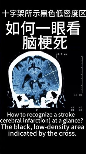 如何一眼看脑梗死？十字架所示黑色低密度区How to recognize a stroke (cerebral infarction) at a glance？ by the cross！ #流量