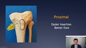 Intraosseous Administration of Prophylactic Antibiotics in TKA - When and How?