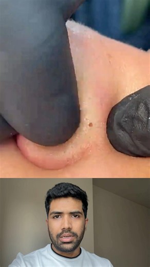 Stubborn Blackhead on the Nose
