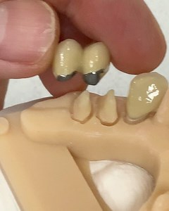 Luke Kahng on Instagram: "2-Unit PFM Bridge with Metal Collars and a Single Unit Metal Ceramic Crown. Case from Dr. Cary Goldberg in Illinois. @envisiontec"