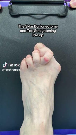 Bunion Surgery Before and After | Sklar Bunionectomy® + Toe Straightening