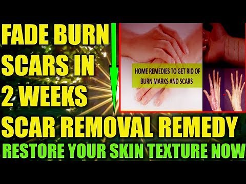 How To Fade Burn Scars Naturally: How To Remove Old Scars Fast After Boiling Water Burn