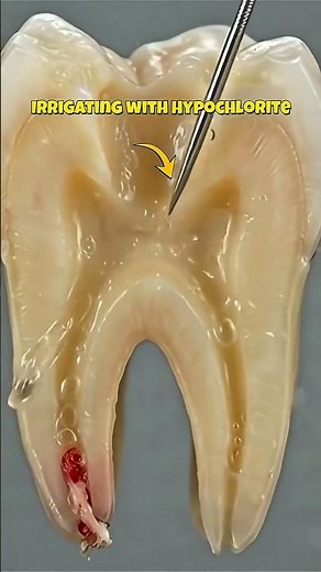 Inside a Root Canal Removing the Nerve! 🦷😳
