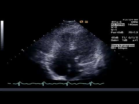 TTE - Large AV Canal Defect with a Common AV Valve