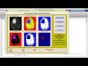 Brain Tumor Detection Using Segmentation Matlab Project with Source Code