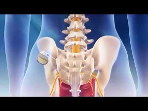 InterStim Therapy by Medtronic for Urinary Control