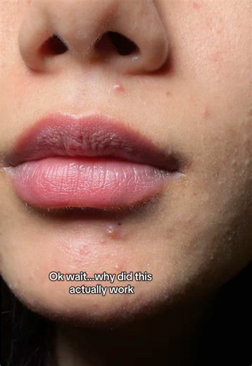 Effective Acne Treatment with Purito Bamboo Cream