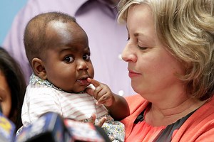 Rare parasitic twin removed surgically from girl's back