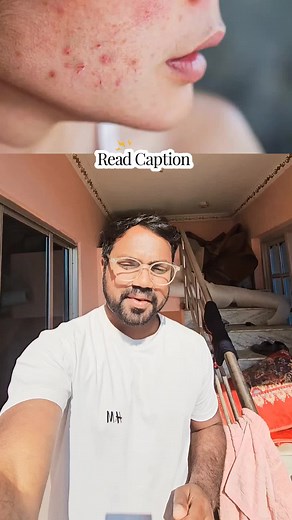 Hyperandrogenism is a medical condition where the body produces too many male hormones (androgens) like testosterone. It can happen in both men and women but is more noticeable in women because their bodies naturally have lower levels of these hormones. Common signs in women include excessive hair growth on the face or body (hirsutism), acne, hair thinning or baldness, irregular periods, or difficulty conceiving. Conditions like polycystic ovary syndrome (PCOS) or certain tumors can cause hypera
