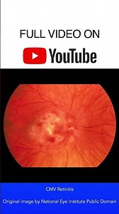CMV Retinitis Fundoscopy