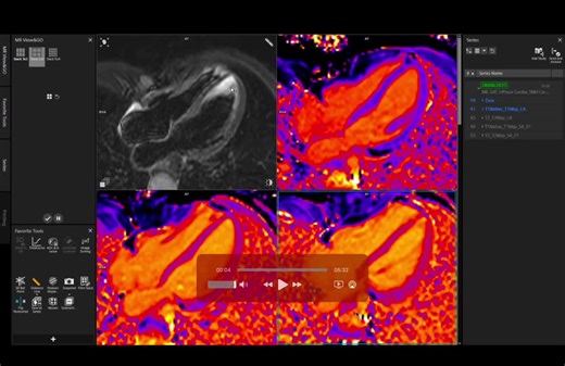 #cmr #scmr #mri #siemenshealthineers #philipsmri #cardiacmri #radiologyprofessionals #1point5tesla #radiologyrounds #cardiology #radiology #gemri #training #eacvi #innovation #imageoptimization… | Stephen Mhiribidi