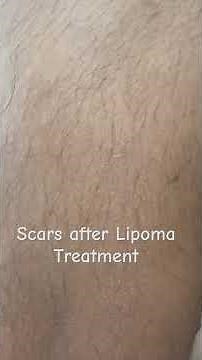 Fat Balls (Lipoma) Removal – Safe, Scar-Minimal Treatment by Dr Ashish Bhanot