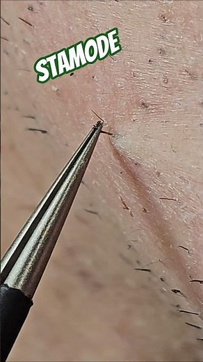 Deep Stuck Hair — Watch the Exact Release 😬 #satisfying #beard #tweezing #facialhair