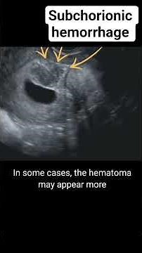 Subchorionic hemorrhage on ultrasound #radiology #ultrasound #pregnancyscan #baby #pregnant