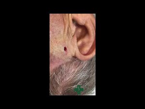 Removal of a Basal Cell Cancer Using a Punch Biopsy