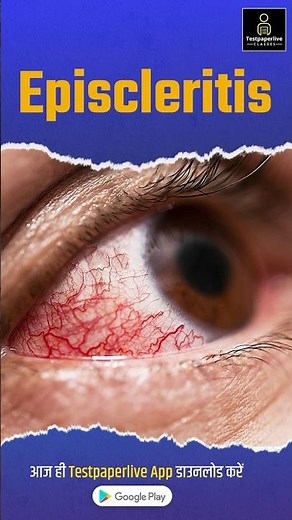 What is Episcleritis ? Ophthalmology | eye #ophthalmology #episcleritis #eye #peramedical