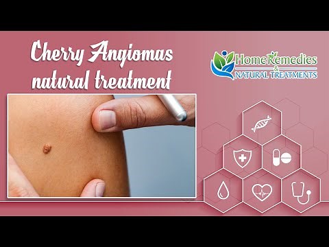 How to remove Cherry Angiomas naturally at home | Home remedie Natural treatments