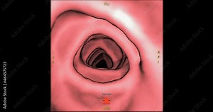 CT colonography 3D movie 4k file for screening colorectal cancer. Check up Screening cancer of colon.
