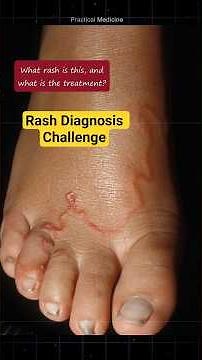 [OSCE: Picture] Which rash is this and what is the treatment?
