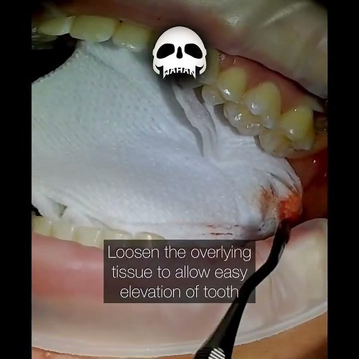 Upper Wisdom Tooth Extraction with 77R Elevator