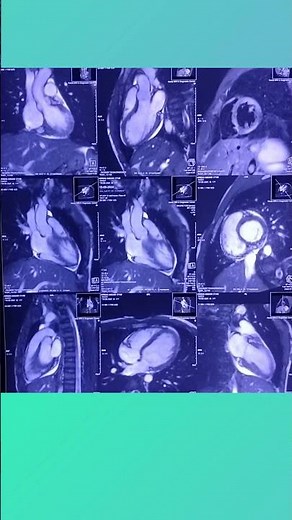 Cardiac mri view anatomy sequences??
