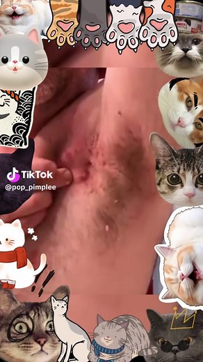 pop #ASMR #pimples #PIMPLE #blackhead #pop #cyst
