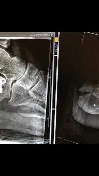 I broke both feet Calcaneus bones video #1