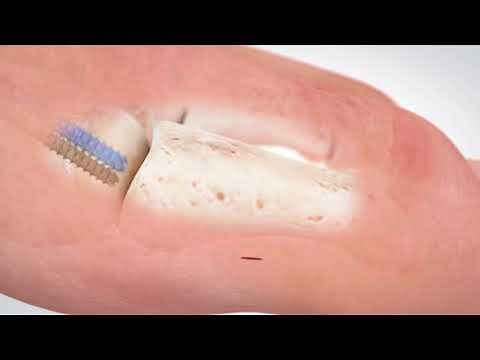 PROstep™ MICA™ Chevron/Akin Animation