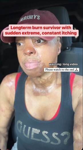 156K views · 767 reactions | To my fellow burn survivors, to burn...