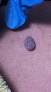 14K views · 77 reactions | a Huge Skin Tag - Laser Removal ✨✍ #Cauterización #lasercut #lasertreatment #safeprocedure #noninvasiveprocedure #skintagsbegone #skintagsremoval | N Lashes and Brows | Facebook