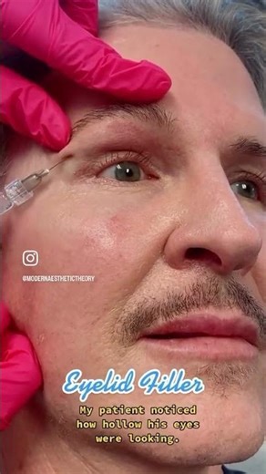 Upper eyelid filler is. used to restore volume to hollow sunken eyes 👀