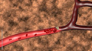 Animation of the formation of thrombosis