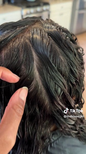 Lice or Dandruff? Head Check Reveals the Truth