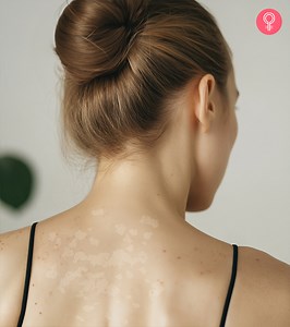 How To Get Rid Of Tinea Versicolor - 15 Home Remedies To Try