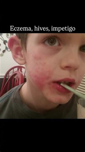 ADD, ODD, Anxiety, adjustment disorder, PANS were actually......