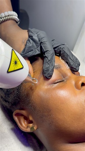 Bad microblading? Don’t cry, just come I’ll erase that mistake like it never happened! #deskinculturespa #deskinculture #bestspainawka #spainawka | Chinelo Stella