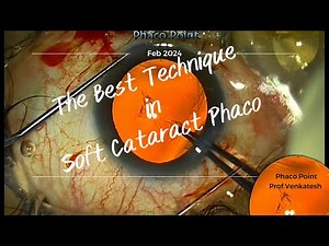The Best Technique In Soft Cataract Phacoemulsification - In my Opinion.
