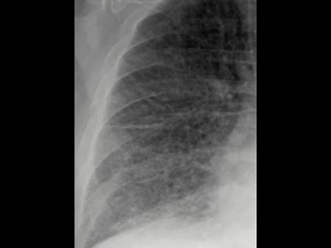 Kerley B lines and interlobular septal thickening on chest radiograph