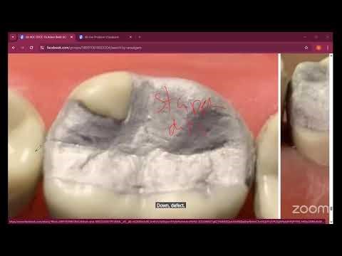 AMALGAM TIPS AND TRICKS BY DR. ADAM AND DR. ALIFIYA